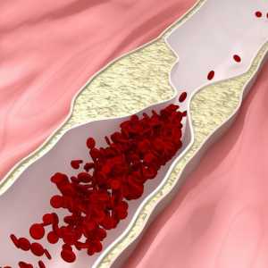 Indikacije za uporabu "Indapamid" - arterijska hipertenzija