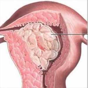Polip endometrija: što je to? Uzroci, simptomi i metode liječenja