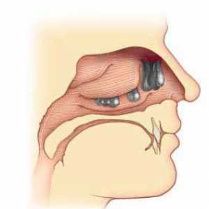 Polipi u nosu: liječenje bez operacije. Liječenje polipa u nosu s narodnim lijekovima