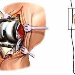 Posljedice ozljeda zglobova koljena. Protetika i rehabilitacija