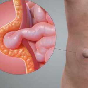 Postoperativna kila na abdomenu: posljedice i liječenje