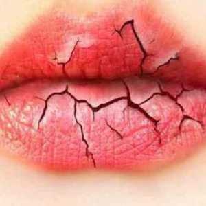 Puknute usne: uzroci i metode liječenja