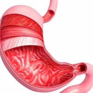 Površni gastritis: što je to? Uzroci, simptomi i metode liječenja