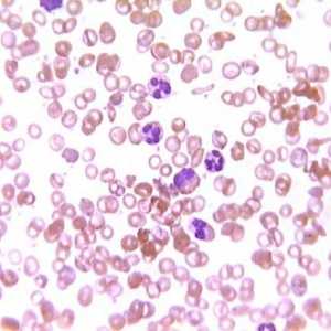 Povišene bijele krvne stanice u krvi: koji su uzroci i što je tretman?