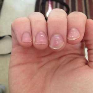 Uzrok bijelih mrlja na noktima: načina da se riješite