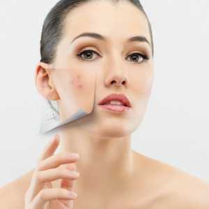 Uzrok unutarnje akne na licu. Kako ukloniti unutarnji bubuljica na licu?