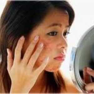 Uzroci akni na licu i kako ih se riješiti