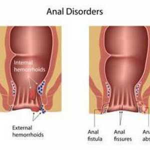 Uzroci i simptomi analnih pukotina. Analni pukotina: metode liječenja narodnim lijekovima
