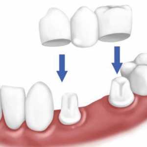 Protetski stomatologija u odsustvu velikog broja zuba: vrsta