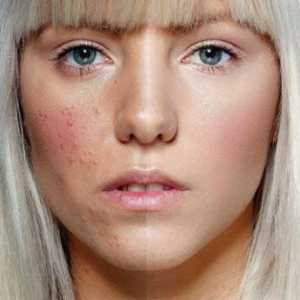 Akne na obrazima žena: uzroci, liječenje, prevencija