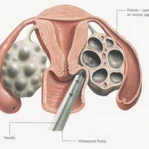 Probijanje folikula s IVF. Priprema za bušenje folikula