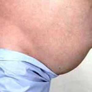 Umbilikalna kila u odraslih: liječenje bez operacije (recenzija)