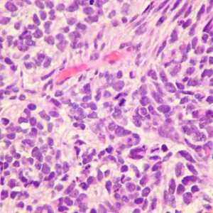 Rak pluća malih stanica: dijagnoza, liječenje, prognozu