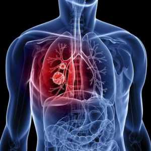 Skvamozni karcinom pluća: opis, uzroci, dijagnoza i karakteristike liječenja