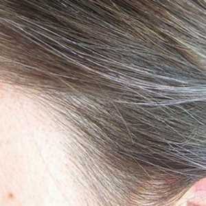 Rana sijeda kosa: uzroci i liječenje kod žena i muškaraca