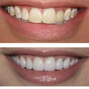 Obnova zuba: prije i poslije. Umjetna obnova zuba