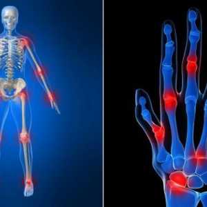 Reumatoidni artritis: simptomi i liječenje