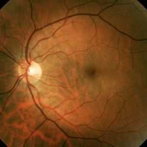 U rožnici oka utječe nedostatak vitamina?