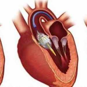 Srčani ventil: operacija za zamjenu i moguće bolesti