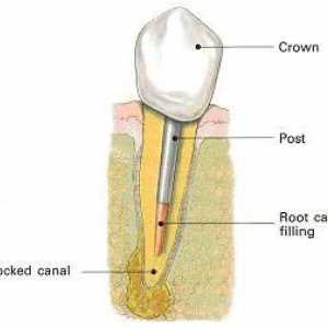 Pins u stomatologiji: instalacija, recenzije, cijene
