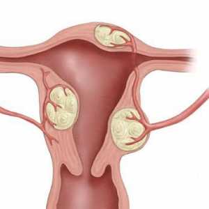 Simptomi i znakovi fibroida maternice: kako prepoznati bolest