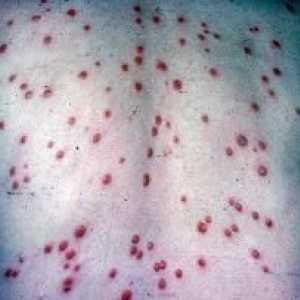 Simptomi sifilisa i prevencije