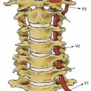 Sindrom vertebralne arterije s cervikalnom osteohondrozom: simptomi i liječenje
