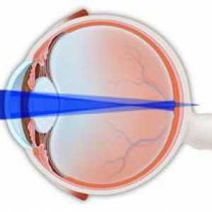 Složeni miopijski astigmatizam oba oka kod djece: liječenje