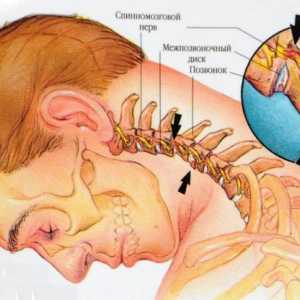 Zamjena cervikalnih kralježaka: simptomi, dijagnoza i liječenje