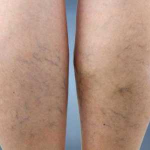 Vaskularna mreža na nogama: kako se riješiti, uzroci i karakteristike liječenja