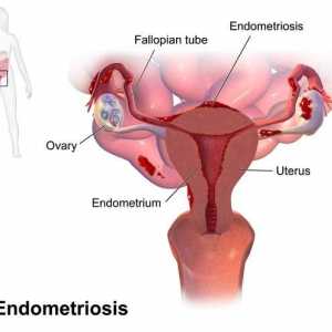 Spiralna `Mirena` na endometriozi: odgovori