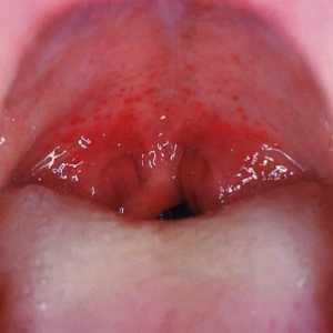 Staphylococcus u grlu i nosu