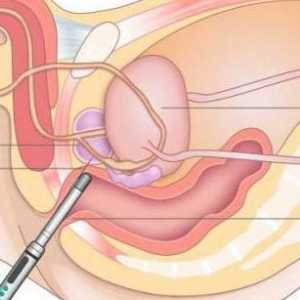 Transrektalni ultrazvuk prostate: opis, priprema i preporuke