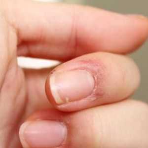 Puknuta koža na prstima blizu noktiju: uzroci i liječenje. Puknuta koža na nožnim prstima