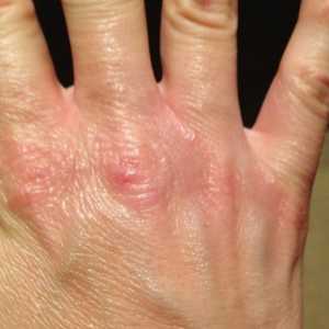 Puknuta koža na prstima: uzroci, liječenje