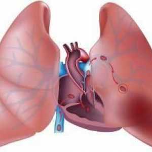 Trombi u plućima. Tromboembolija plućne arterije: uzroci, simptomi, učinci, liječenje