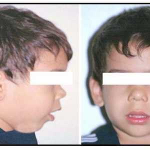 Uklanjanje adenoida u djetetu: recenzije i posljedice