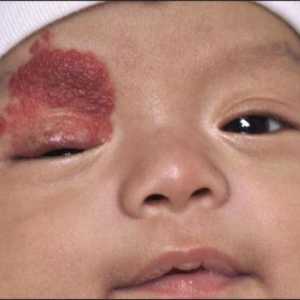 Uklanjanje hemangioma laserom kod djece i odraslih: kontraindikacije i skrb nakon postupka