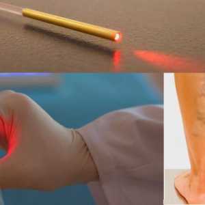 Lasersko uklanjanje vena: pregled, učinci i rehabilitacija