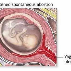 Prijetnja pobačaju: uzroci, simptomi i značajke liječenja