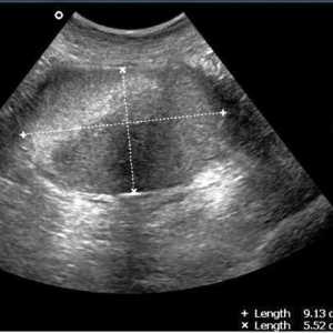 Ultrazvuk malih zdjelica kada treba učiniti: prije ili poslije mjeseca?
