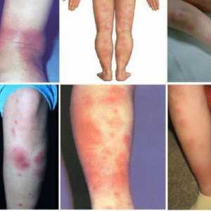 Nodularna eritema na nogama: simptomi, uzroci, liječenje
