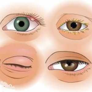 Oči kapaka: bolesti očnih kapaka. Bolesti i patologije kapaka
