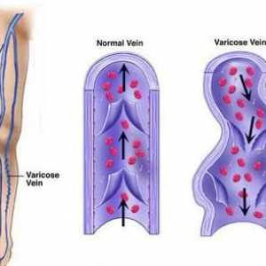 Venotonici za varicozu nogu: opis preparata