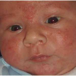 Vesikulopustuloza u novorođenčadi: patogeni, simptomi i liječenje