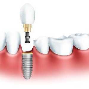 Vrste zubnih implantata: opis, prednosti i nedostatke, fotografija