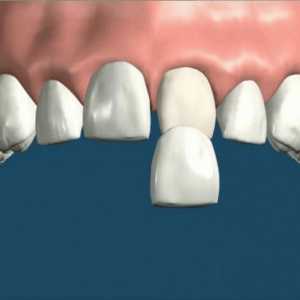 Vrata na zubima: prednosti elementa, svojstva instalacije i indikacije za uporabu