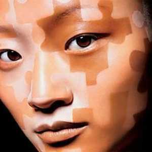 Što je Vitiligo? Uzroci, simptomi i liječenje vitiliga