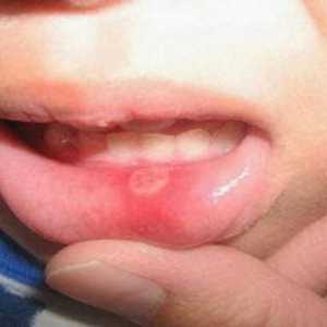 U ustima, bubuljica: uzroci i metode liječenja
