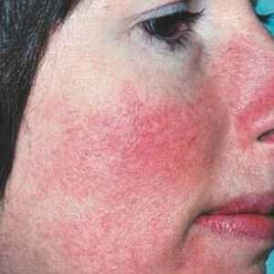 Upala kože na licu: uzroci, tipovi, prevencije i mogućnosti liječenja